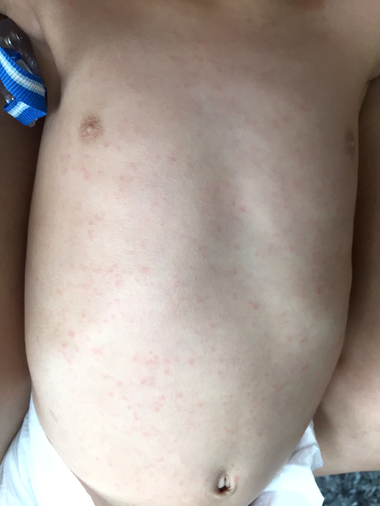 Fever And Baby Rash At Luis Silver Blog